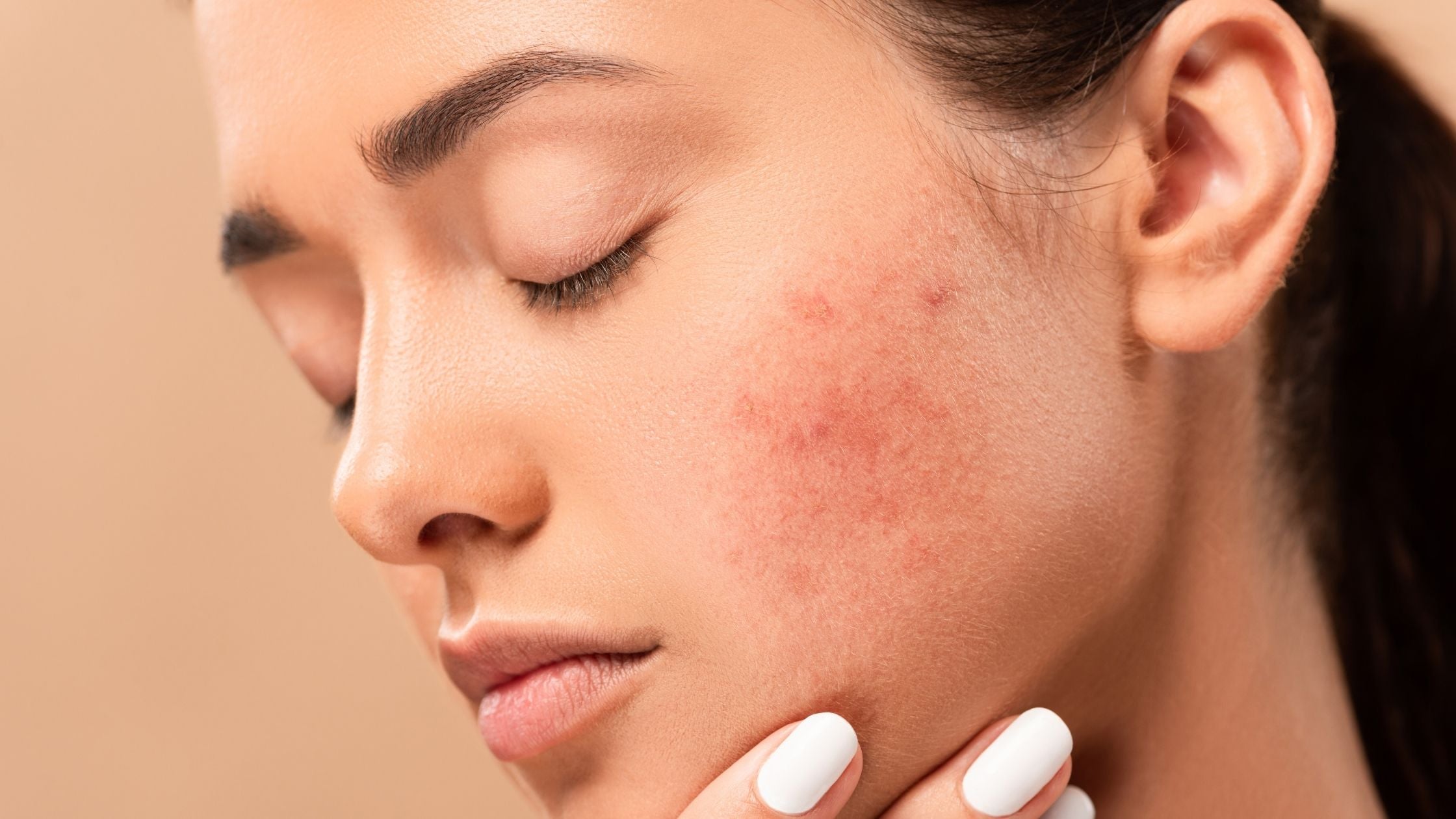 What is hormonal acne? What is hormonal acne?