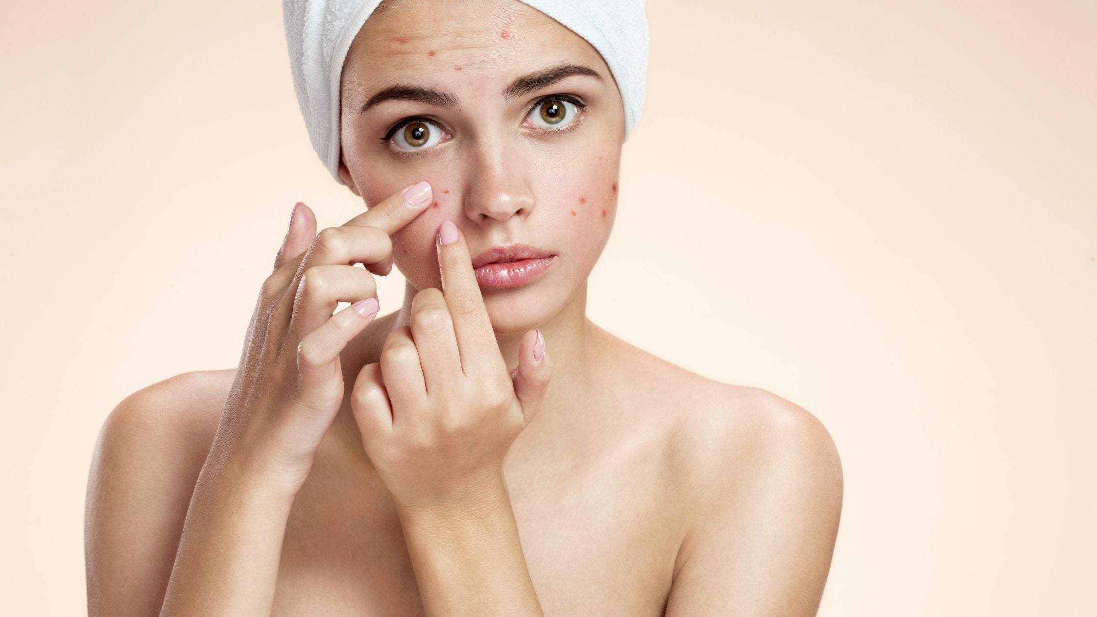 Can Acne Cause Hyperpigmentation? Can Acne Cause Hyperpigmentation?
