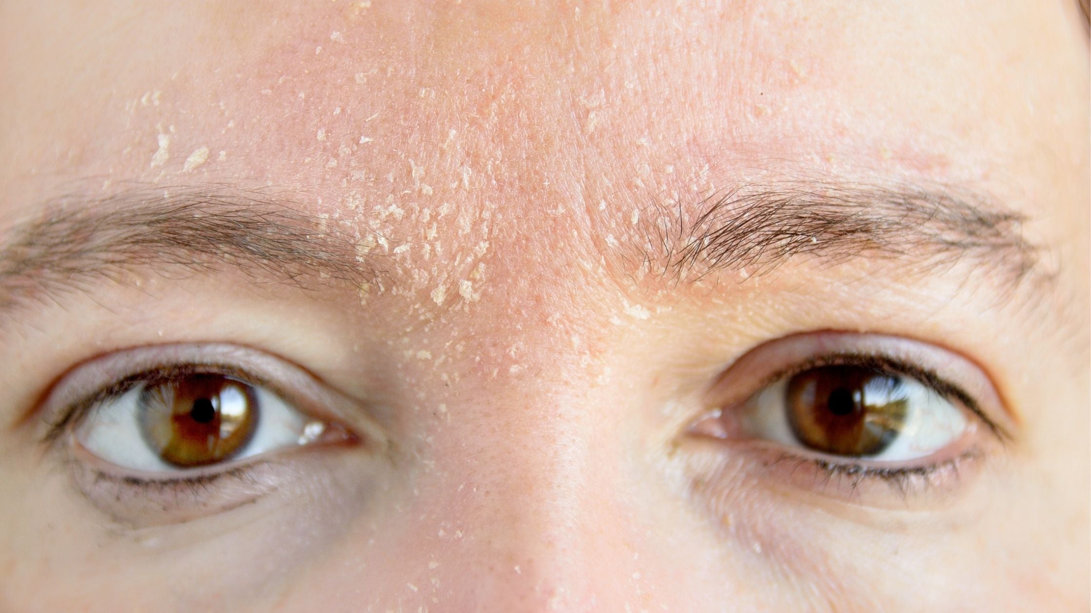 How To Take Care of Dry Skin How To Take Care of Dry Skin