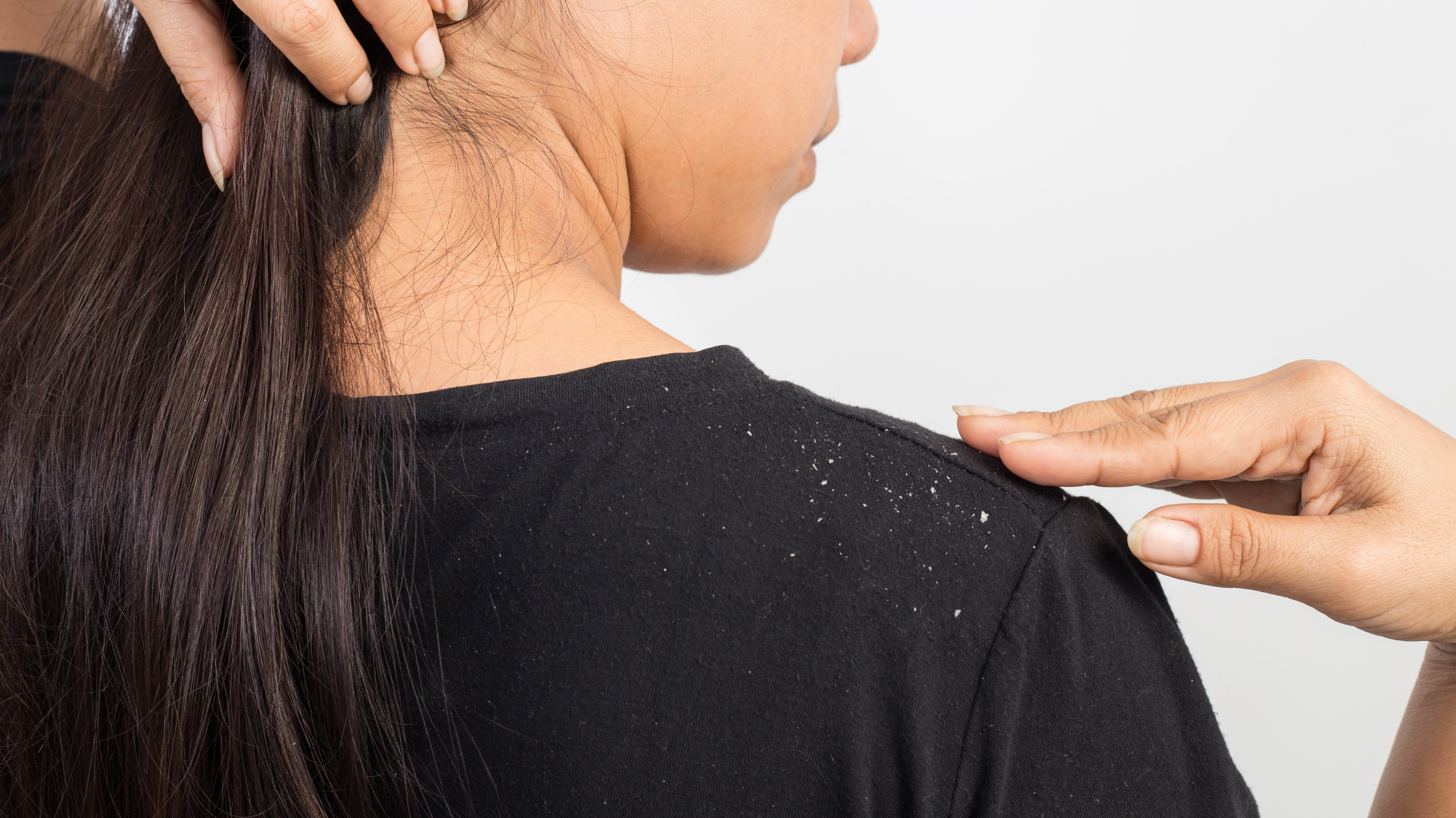 How You Can Prevent Your Scalp