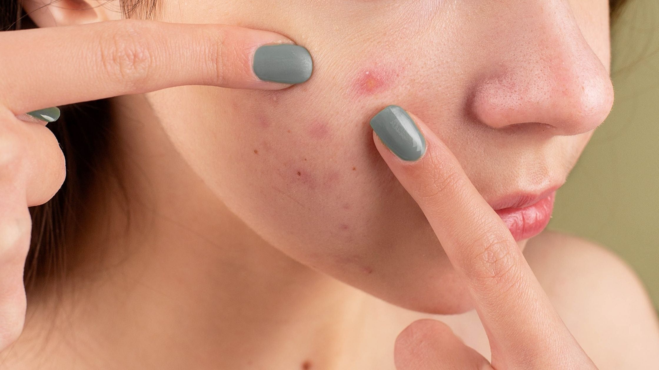 prevent and reduce acne scars or pimple marks prevent and reduce acne scars or pimple marks