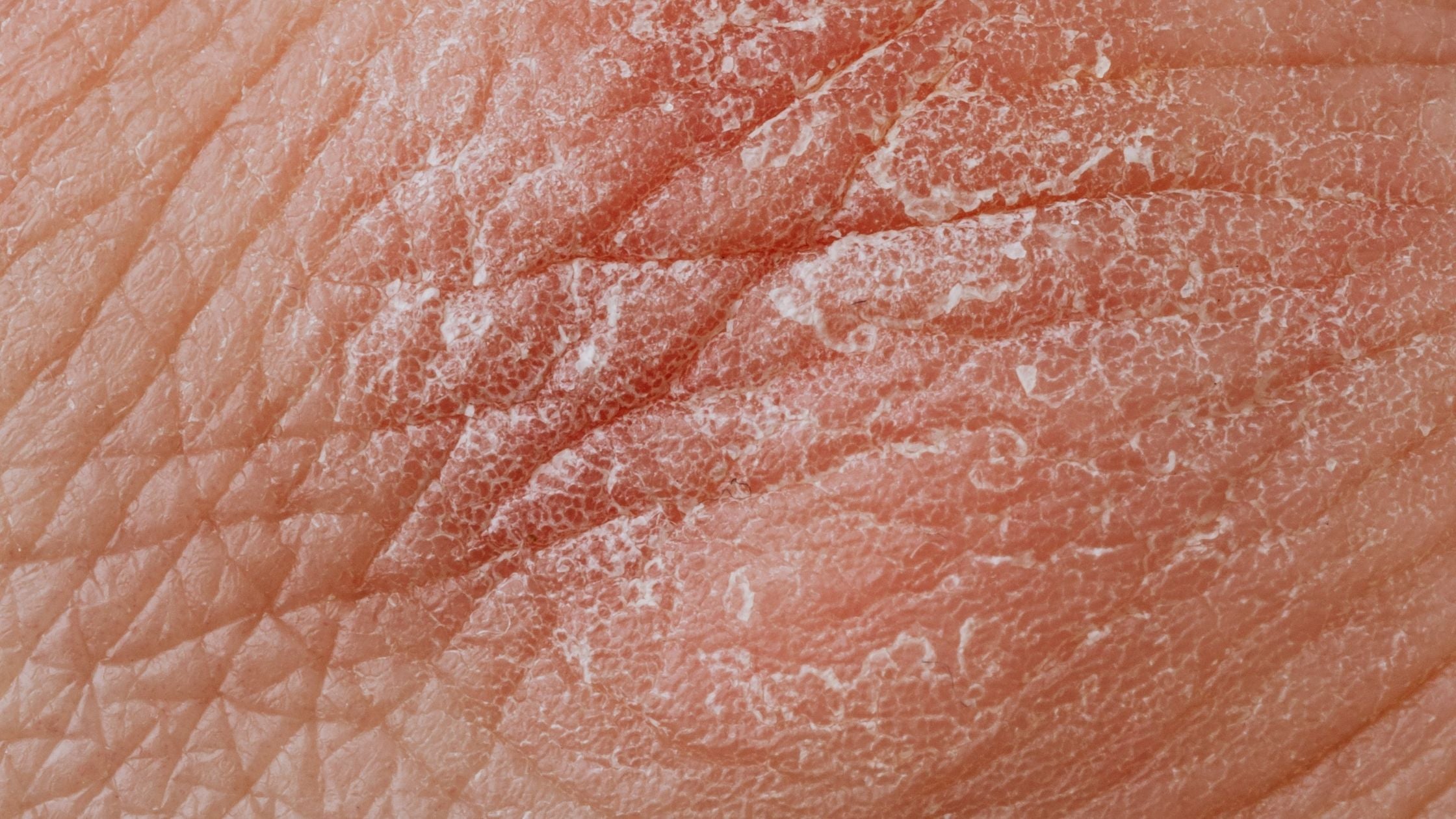Is Psoriasis a Serious Skin Condition? Is Psoriasis a Serious Skin Condition?