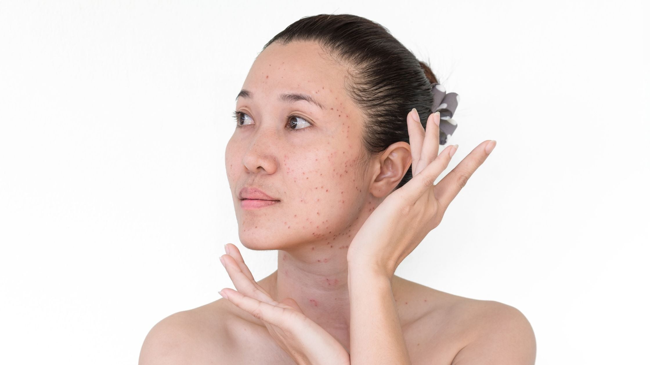 How to remove & prevent Age spots? How to remove & prevent Age spots?