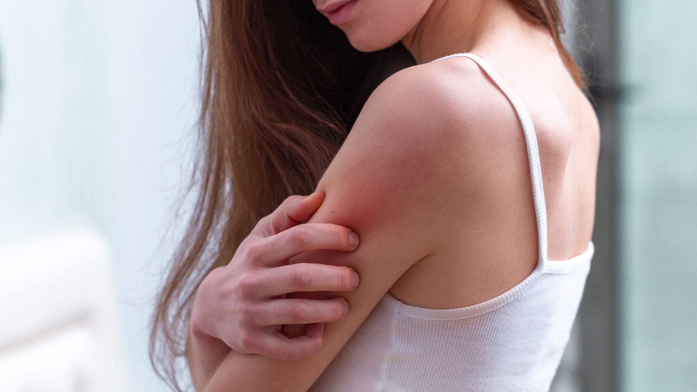 How to Avoid and Treat Heat Rashes How to Avoid and Treat Heat Rashes