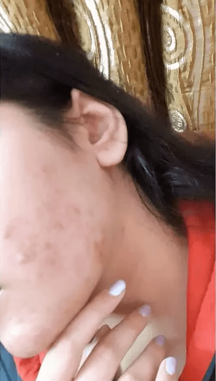 Analyze skin after Acne
