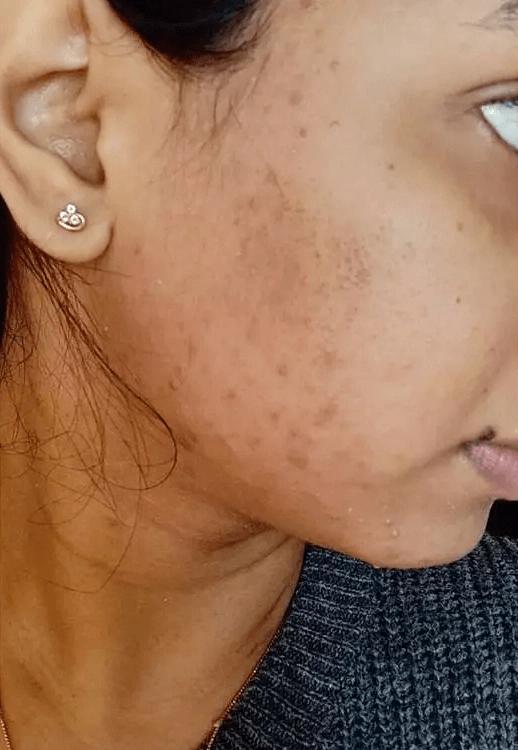 Analyze skin before Pores