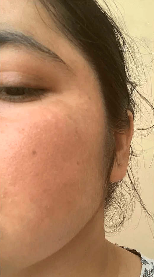 Analyze skin after Pigmentation