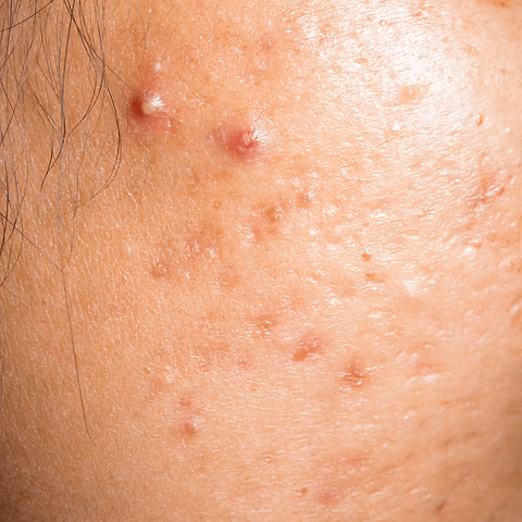 shop with Acne control