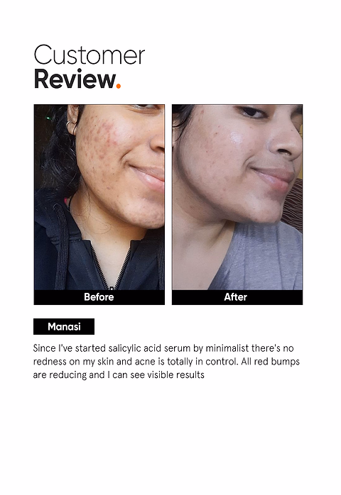 Salicylic Acid 2% Face Serum